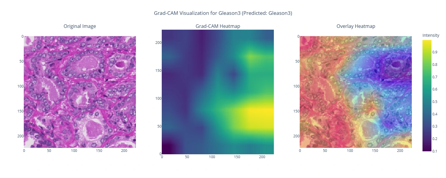 Gleason Score Classifier